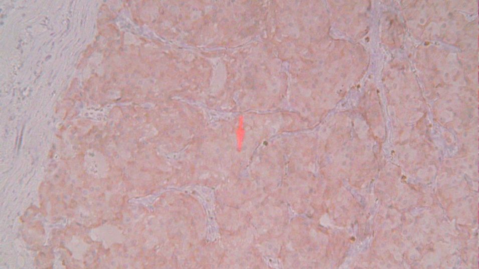 Insulinom
