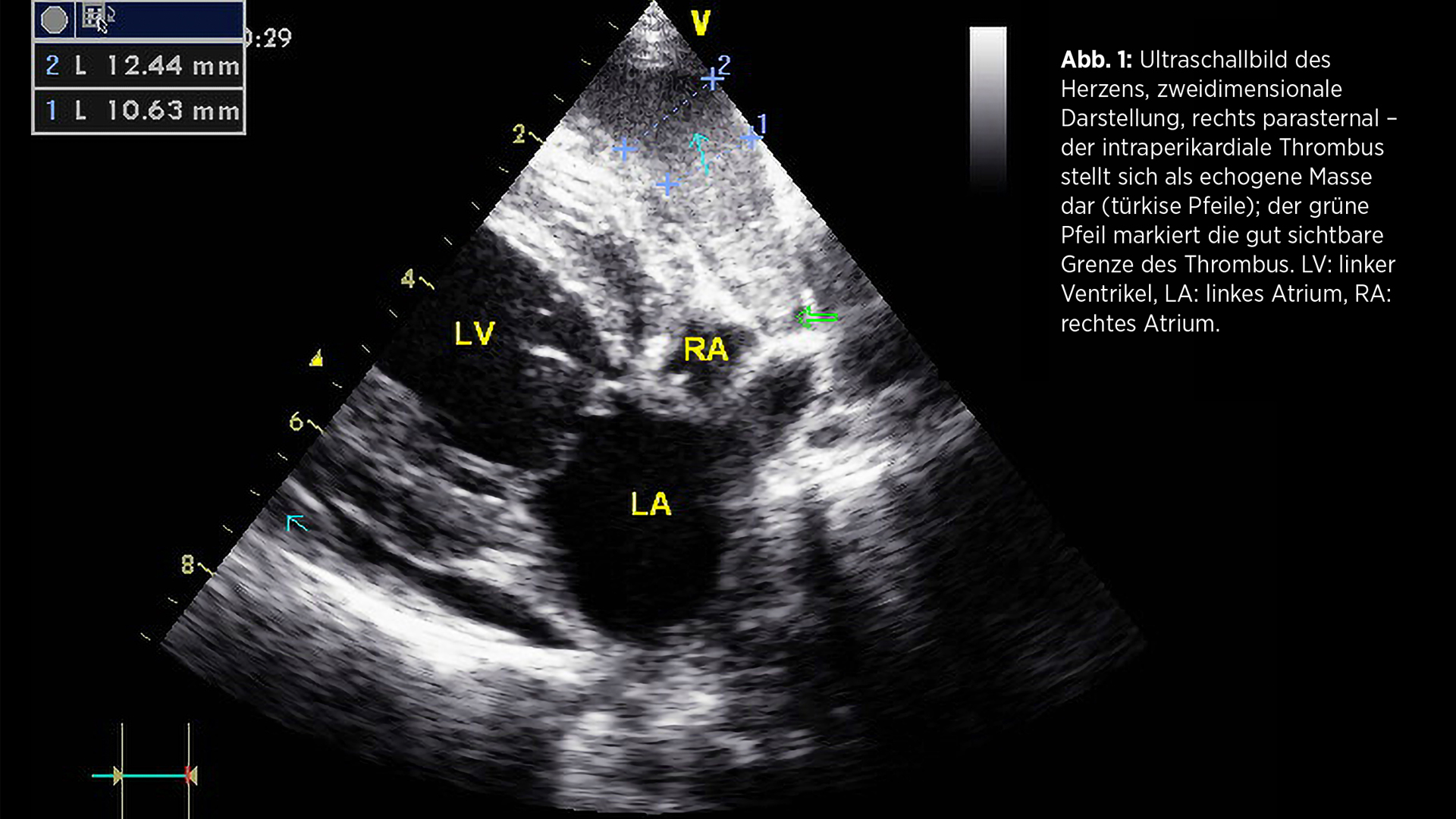 Vorhofruptur (atrial tear)