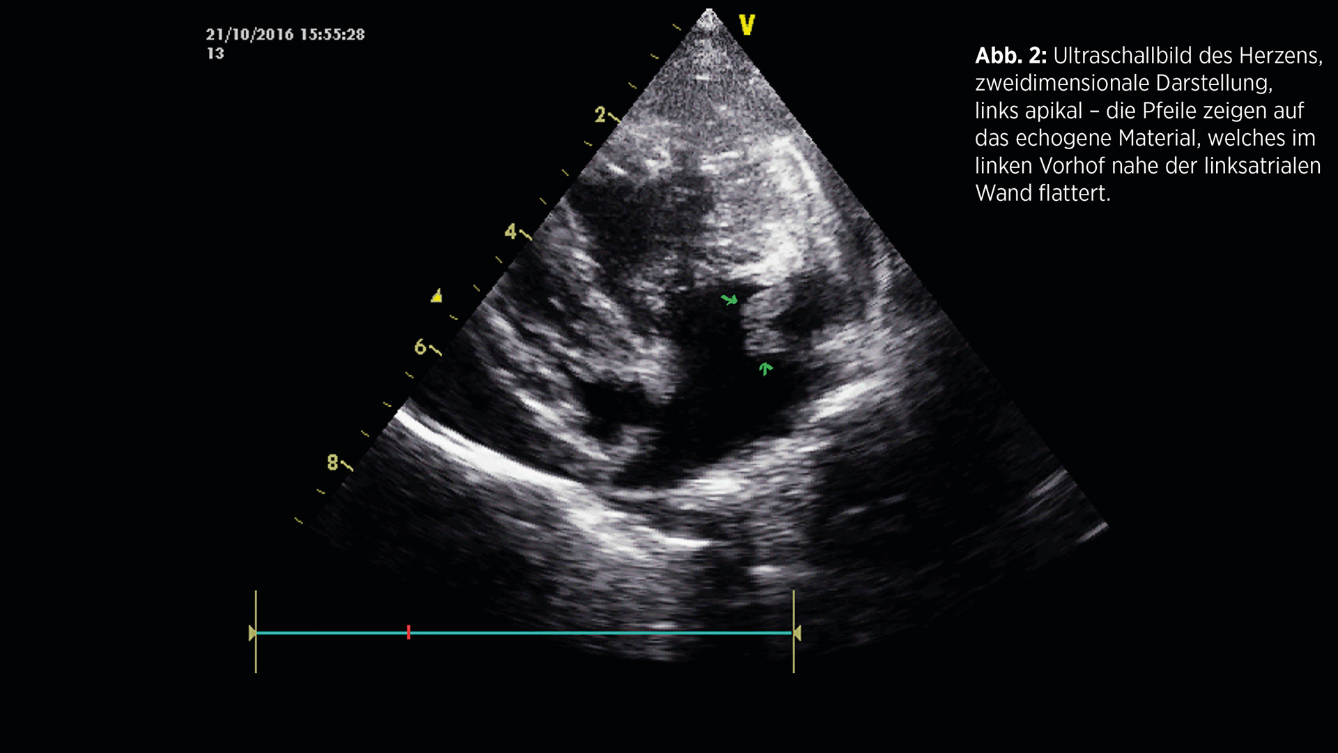 Vorhofruptur (atrial tear)