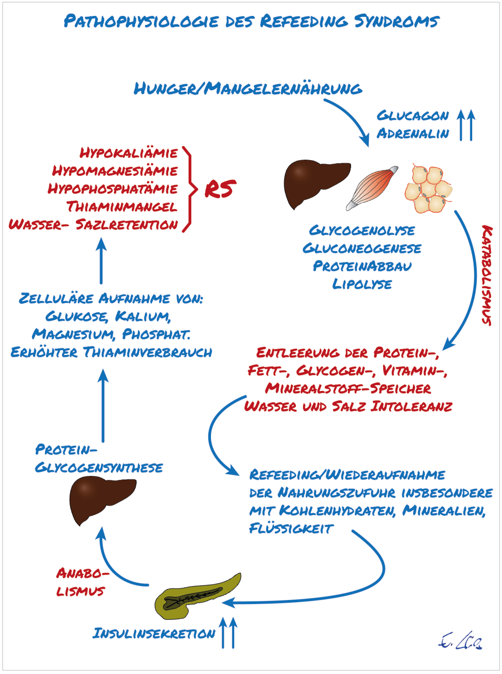 Refeeding-Syndrom