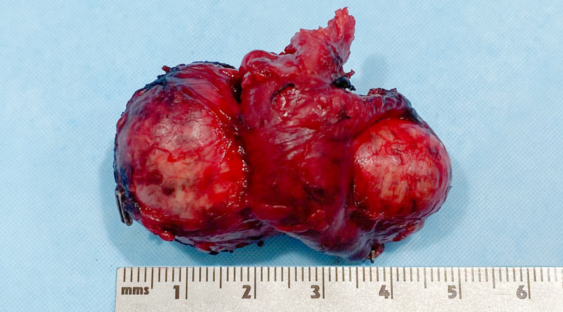 Erfolgreiche chirurgische Resektion eines infiltrativ wachsenden Phäochromozytoms