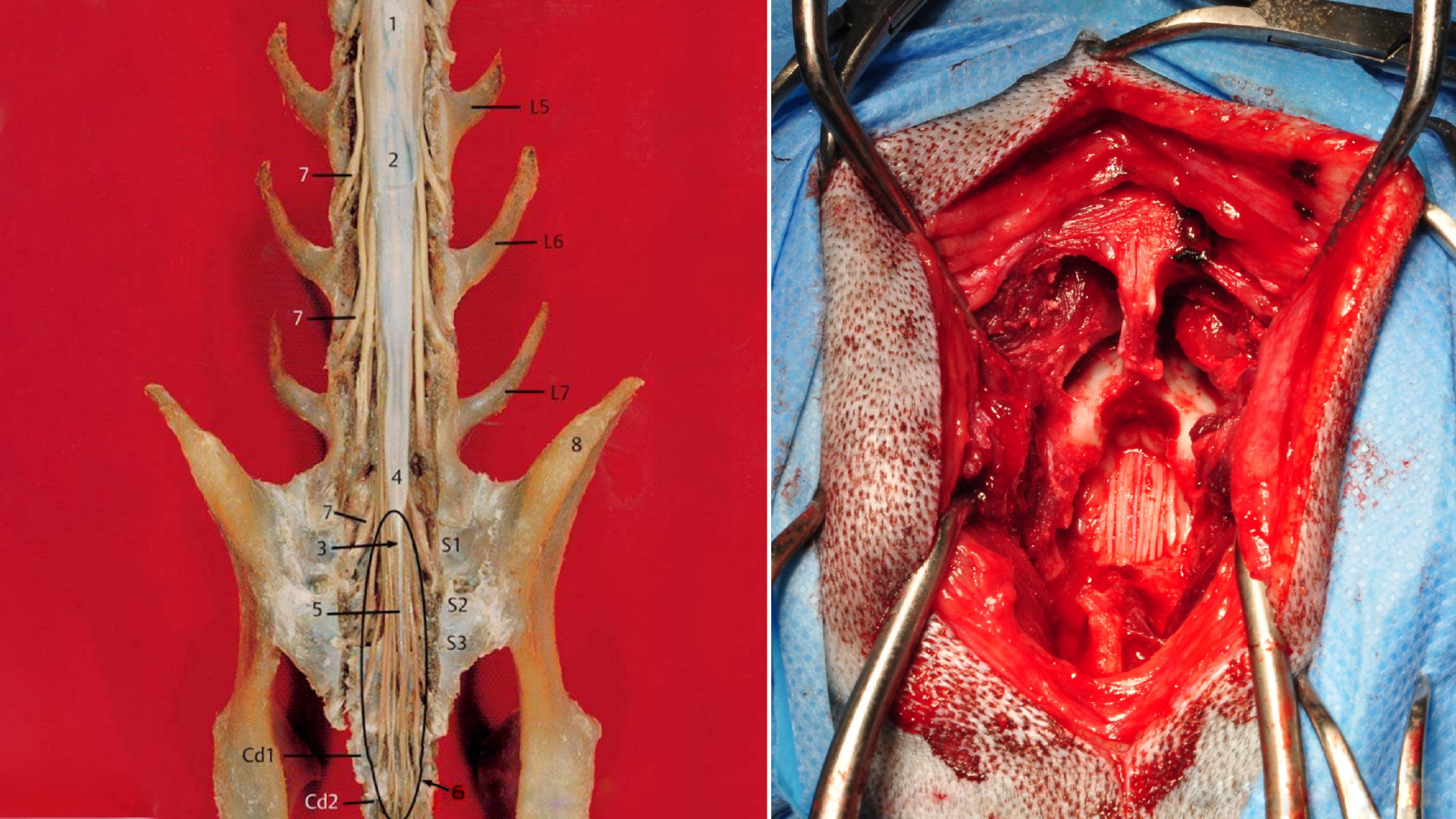 Cauda-equina-Syndrom