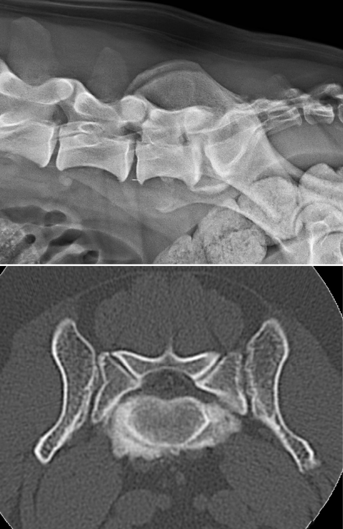 Cauda-equina-Syndrom