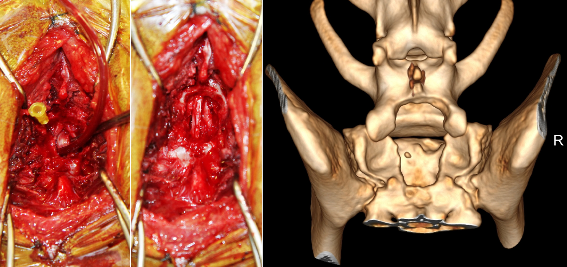 Cauda-equina-Syndrom