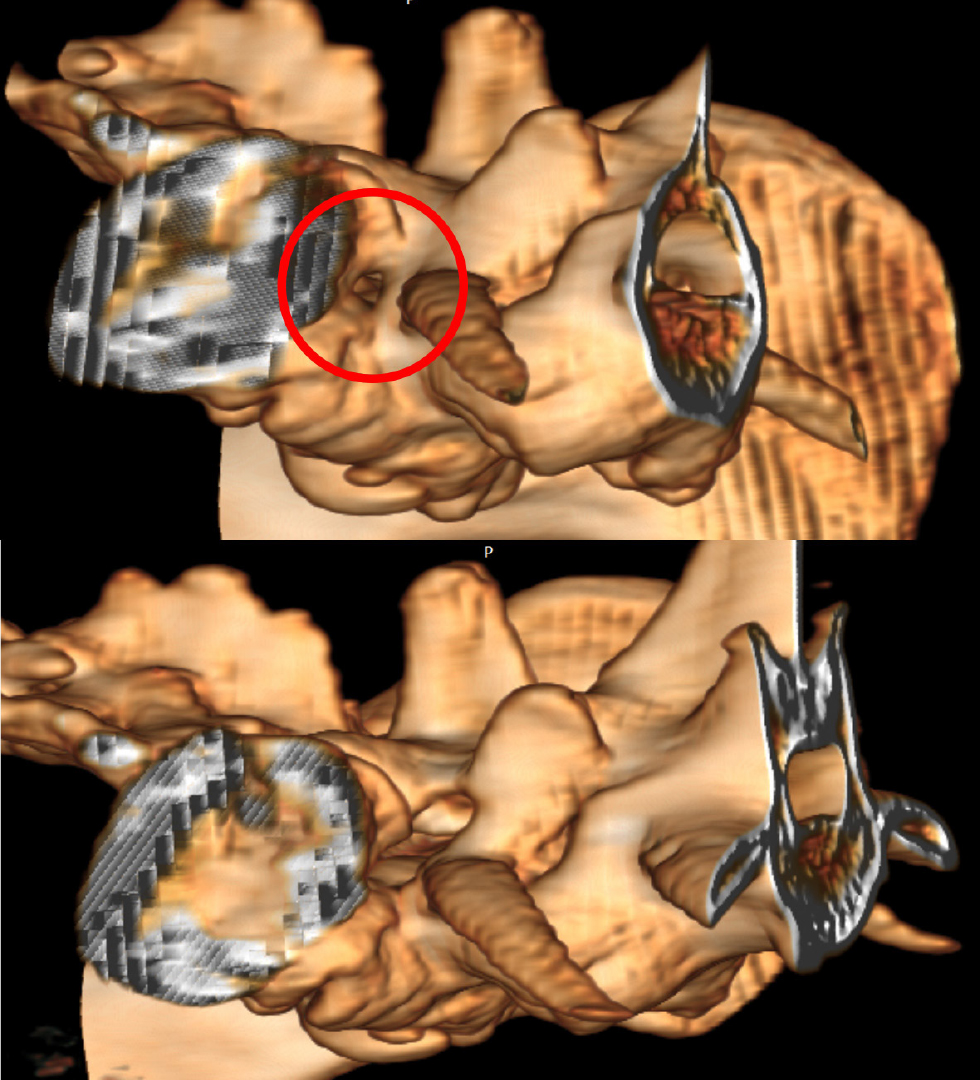 Cauda-equina-Syndrom