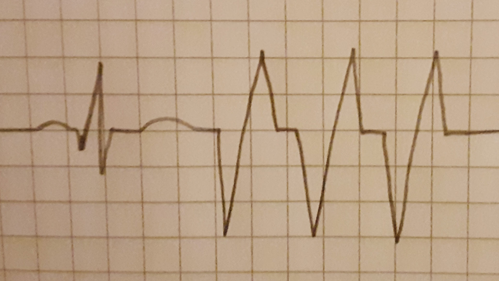 Dobermann-Kardiomyopathie
